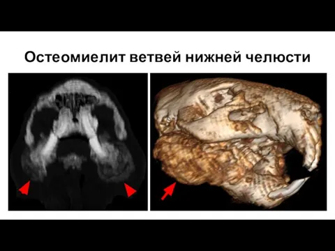 Остеомиелит ветвей нижней челюсти