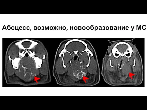 Абсцесс, возможно, новообразование у МС