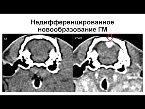 Недифференцированное новообразование ГМ