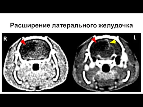 Расширение латерального желудочка