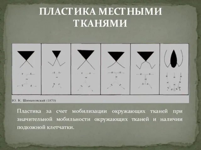 Пластика за счет мобилизации окружающих тканей при значительной мобильности окружающих тканей