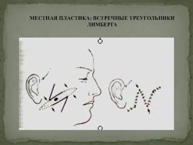 МЕСТНАЯ ПЛАСТИКА: ВСТРЕЧНЫЕ ТРЕУГОЛЬНИКИ ЛИМБЕРГА