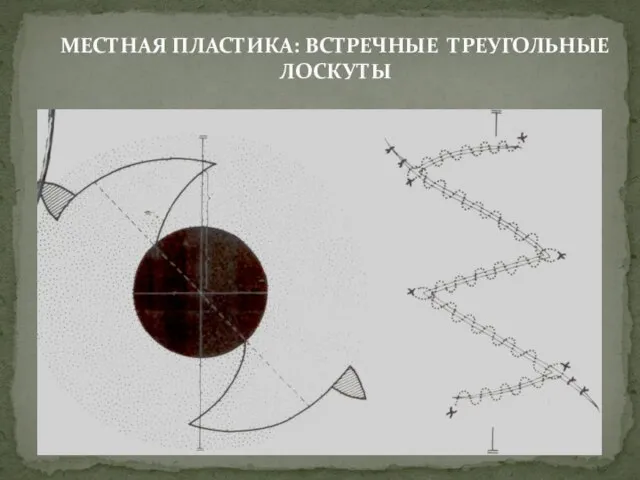 МЕСТНАЯ ПЛАСТИКА: ВСТРЕЧНЫЕ ТРЕУГОЛЬНЫЕ ЛОСКУТЫ