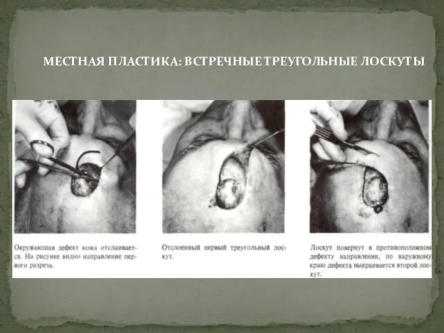 МЕСТНАЯ ПЛАСТИКА: ВСТРЕЧНЫЕ ТРЕУГОЛЬНЫЕ ЛОСКУТЫ