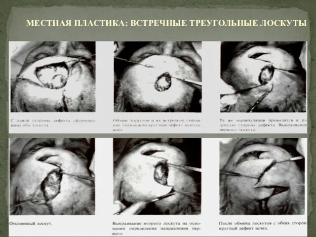 МЕСТНАЯ ПЛАСТИКА: ВСТРЕЧНЫЕ ТРЕУГОЛЬНЫЕ ЛОСКУТЫ