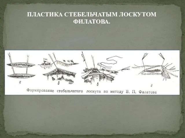 ПЛАСТИКА СТЕБЕЛЬЧАТЫМ ЛОСКУТОМ ФИЛАТОВА.