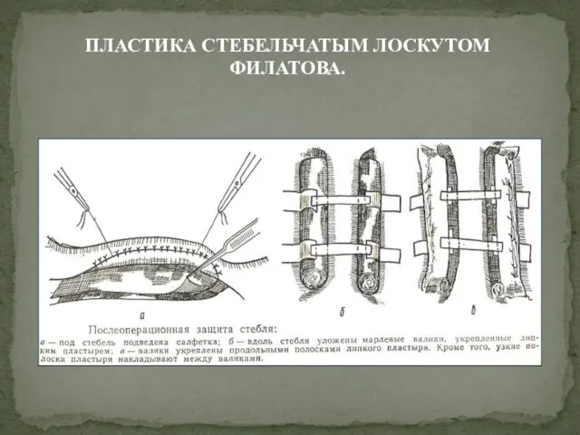 ПЛАСТИКА СТЕБЕЛЬЧАТЫМ ЛОСКУТОМ ФИЛАТОВА.