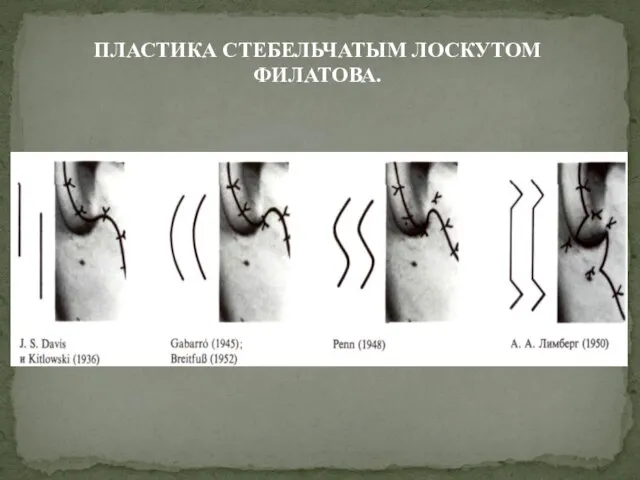 ПЛАСТИКА СТЕБЕЛЬЧАТЫМ ЛОСКУТОМ ФИЛАТОВА.