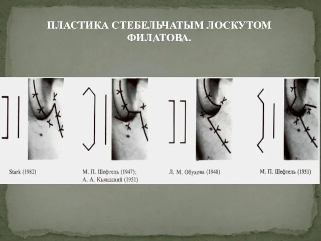 ПЛАСТИКА СТЕБЕЛЬЧАТЫМ ЛОСКУТОМ ФИЛАТОВА.