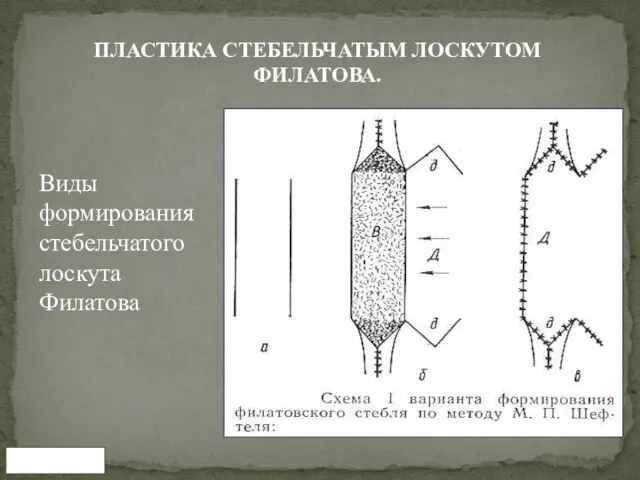 www.tma.uz ПЛАСТИКА СТЕБЕЛЬЧАТЫМ ЛОСКУТОМ ФИЛАТОВА. Виды формирования стебельчатого лоскута Филатова