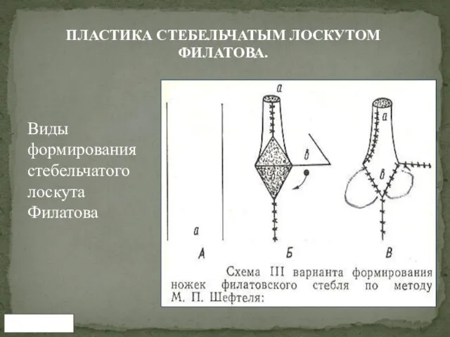 www.tma.uz ПЛАСТИКА СТЕБЕЛЬЧАТЫМ ЛОСКУТОМ ФИЛАТОВА. Виды формирования стебельчатого лоскута Филатова