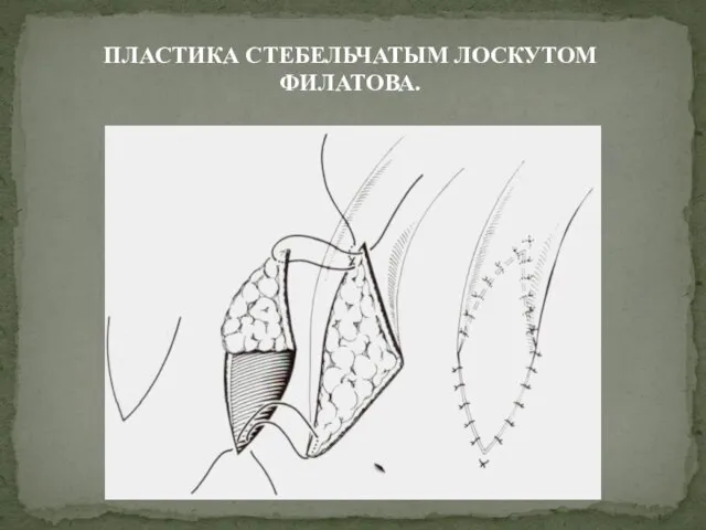 ПЛАСТИКА СТЕБЕЛЬЧАТЫМ ЛОСКУТОМ ФИЛАТОВА.