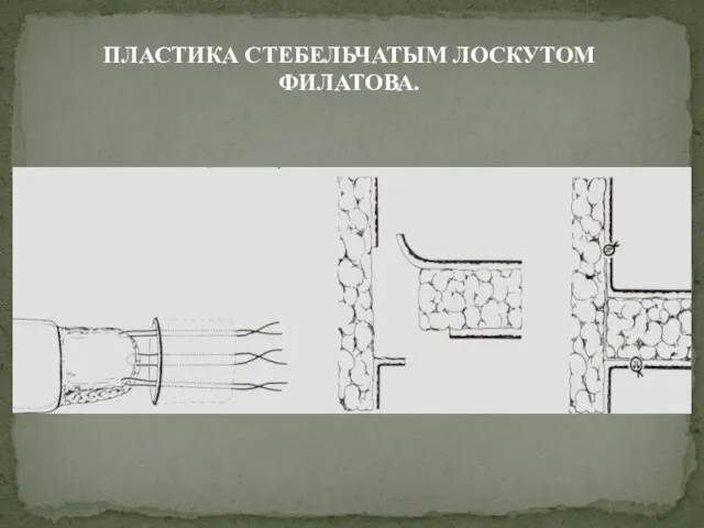 ПЛАСТИКА СТЕБЕЛЬЧАТЫМ ЛОСКУТОМ ФИЛАТОВА.