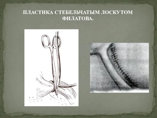 ПЛАСТИКА СТЕБЕЛЬЧАТЫМ ЛОСКУТОМ ФИЛАТОВА.