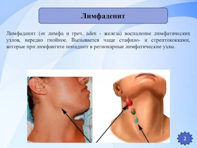 Лимфаденит (от лимфа и греч. aden - железа) воспаление лимфатических узлов,