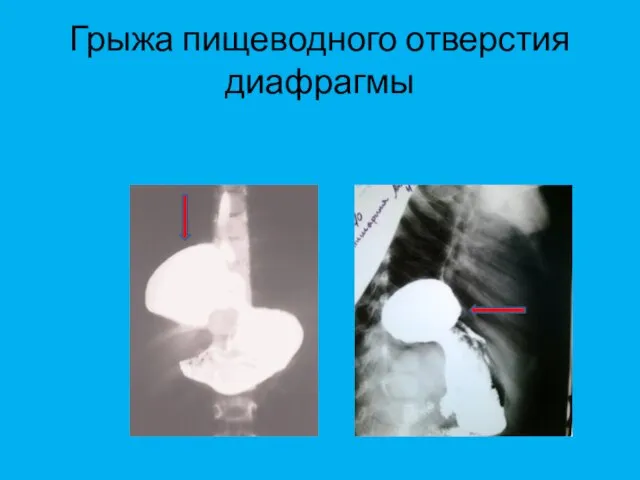 Грыжа пищеводного отверстия диафрагмы