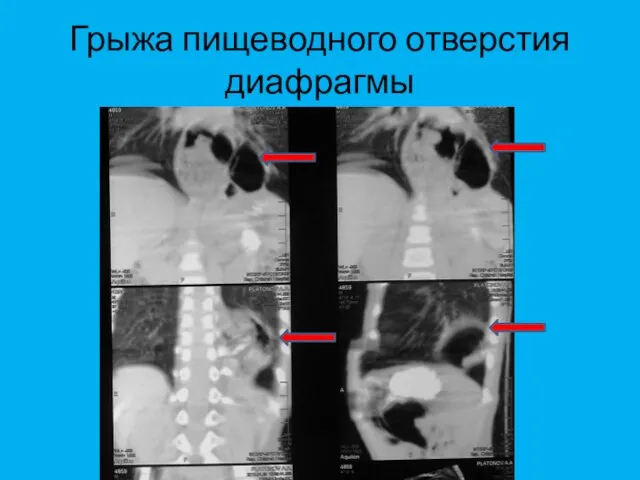 Грыжа пищеводного отверстия диафрагмы