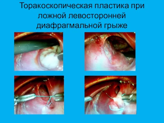 Торакоскопическая пластика при ложной левосторонней диафрагмальной грыже