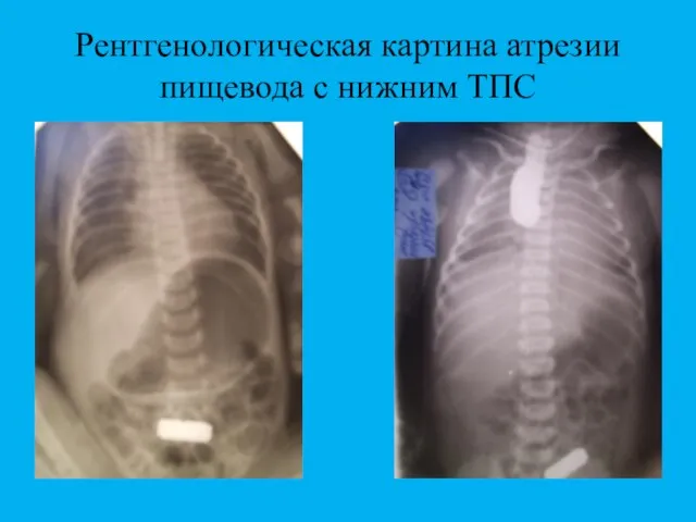 Рентгенологическая картина атрезии пищевода с нижним ТПС