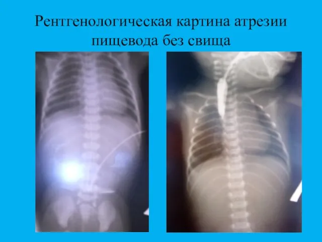 Рентгенологическая картина атрезии пищевода без свища