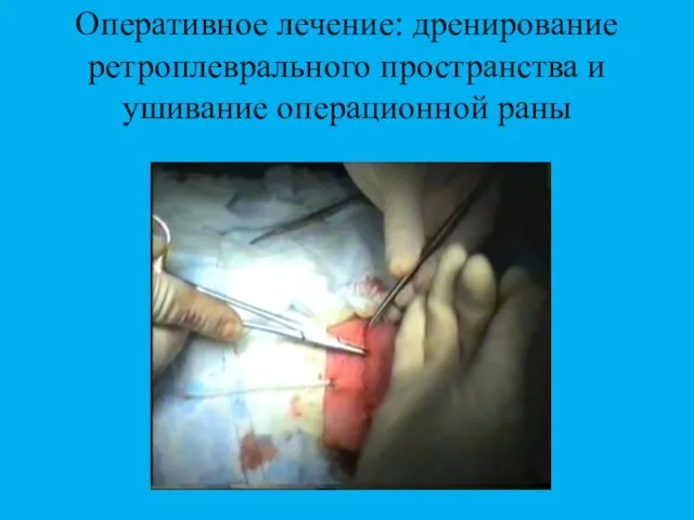 Оперативное лечение: дренирование ретроплеврального пространства и ушивание операционной раны