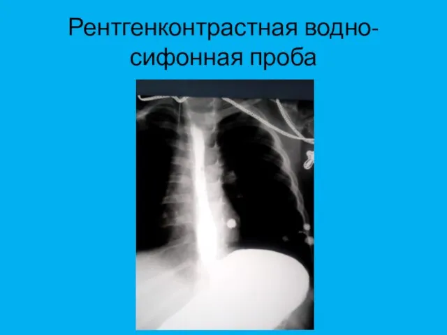 Рентгенконтрастная водно-сифонная проба