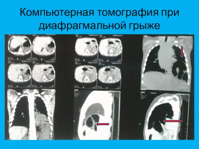 Компьютерная томография при диафрагмальной грыже