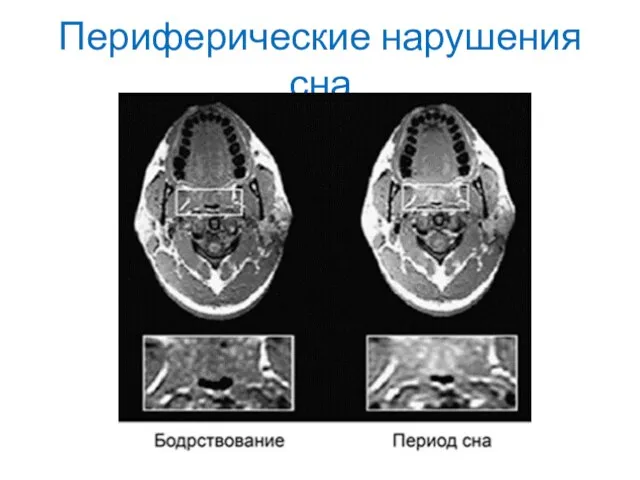 Периферические нарушения сна