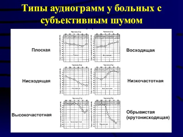 Типы аудиограмм у больных с субъективным шумом