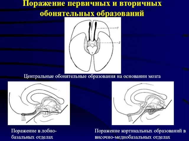 Поражение первичных и вторичных обонятельных образований Поражение в лобно-базальных отделах Поражение