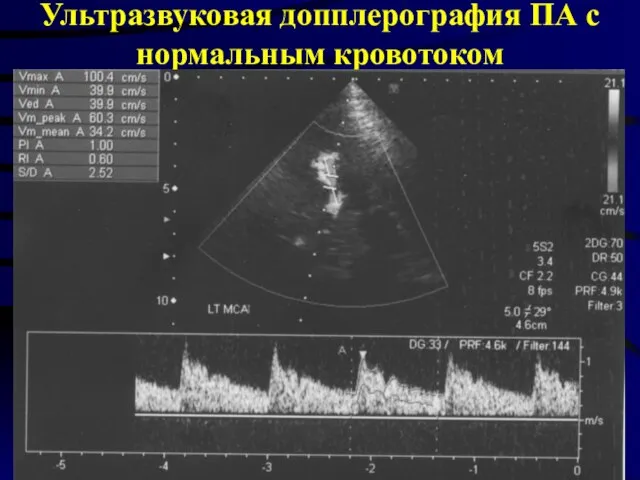 Ультразвуковая допплерография ПА с нормальным кровотоком