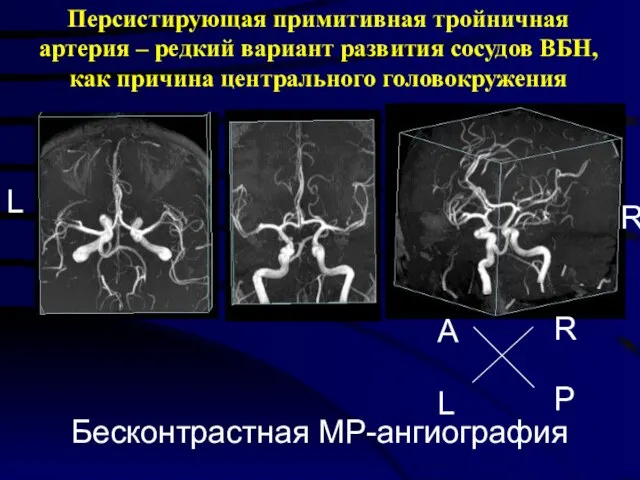 Персистирующая примитивная тройничная артерия – редкий вариант развития сосудов ВБН, как