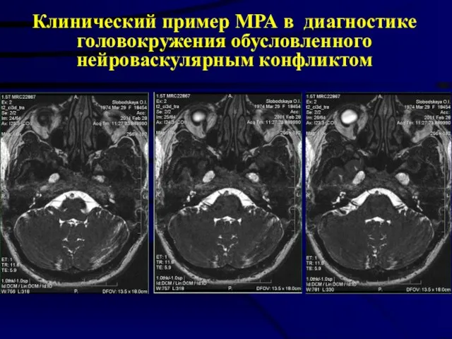 Клинический пример МРА в диагностике головокружения обусловленного нейроваскулярным конфликтом