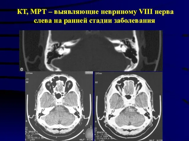 КТ, МРТ – выявляющие невриному VIII нерва слева на ранней стадии заболевания