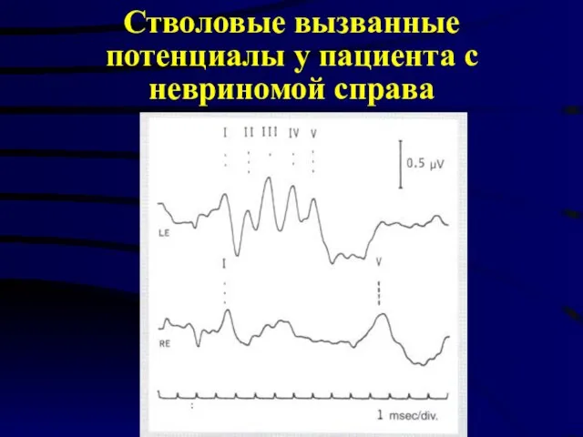 Стволовые вызванные потенциалы у пациента с невриномой справа