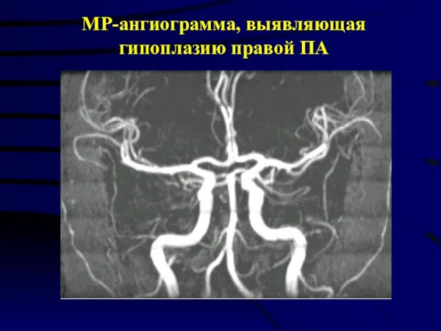 МР-ангиограмма, выявляющая гипоплазию правой ПА