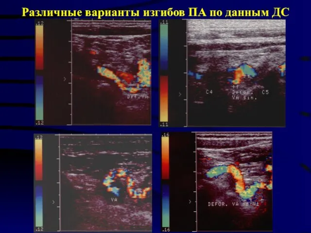 Различные варианты изгибов ПА по данным ДС