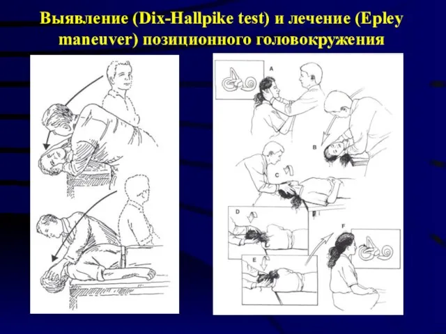 Выявление (Dix-Hallpike test) и лечение (Epley maneuver) позиционного головокружения