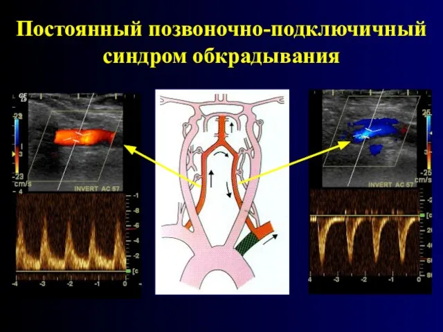 Постоянный позвоночно-подключичный синдром обкрадывания