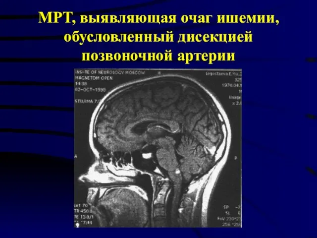 МРТ, выявляющая очаг ишемии, обусловленный дисекцией позвоночной артерии