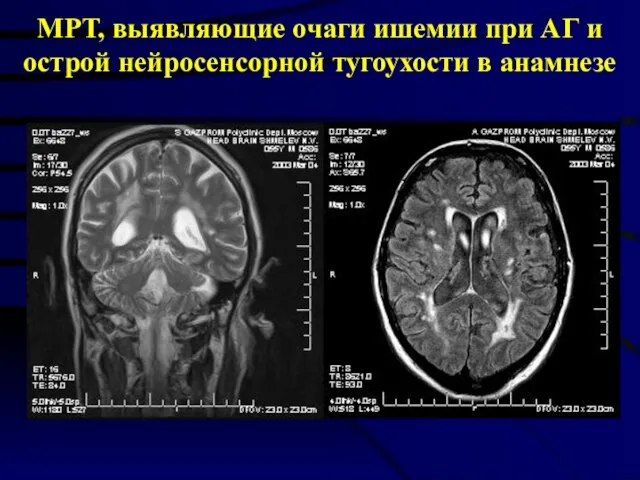 МРТ, выявляющие очаги ишемии при АГ и острой нейросенсорной тугоухости в анамнезе