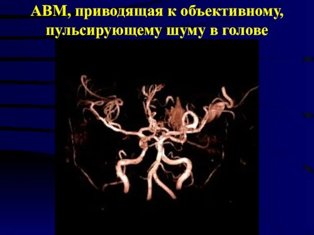 АВМ, приводящая к объективному, пульсирующему шуму в голове