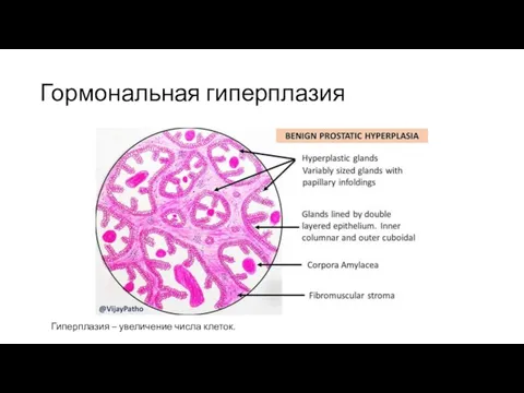 Гормональная гиперплазия Гиперплазия – увеличение числа клеток.