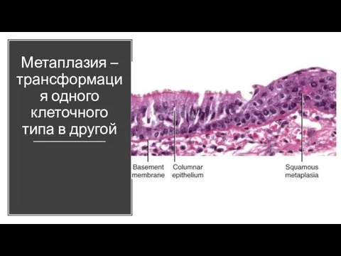 Метаплазия – трансформация одного клеточного типа в другой
