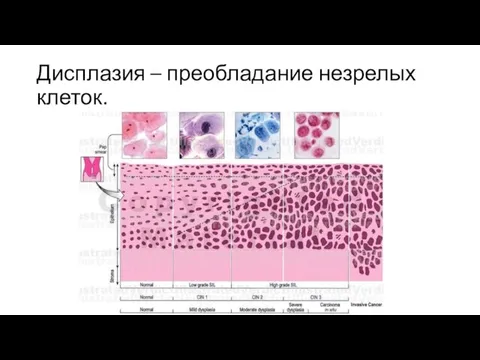 Дисплазия – преобладание незрелых клеток.