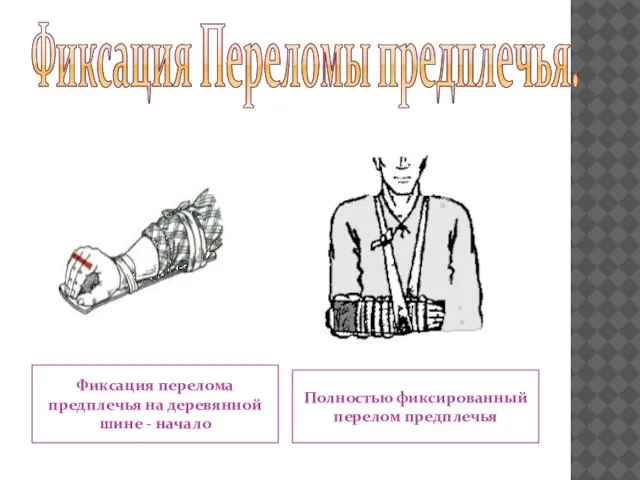 Фиксация Переломы предплечья. Фиксация перелома предплечья на деревянной шине - начало Полностью фиксированный перелом предплечья