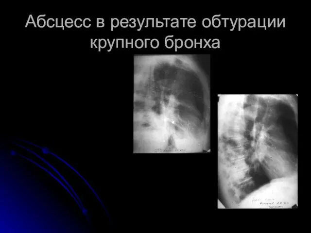 Абсцесс в результате обтурации крупного бронха