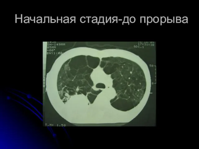 Начальная стадия-до прорыва