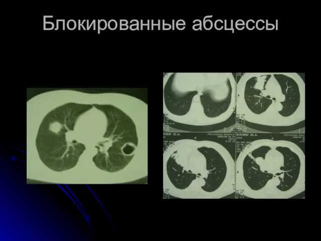 Блокированные абсцессы