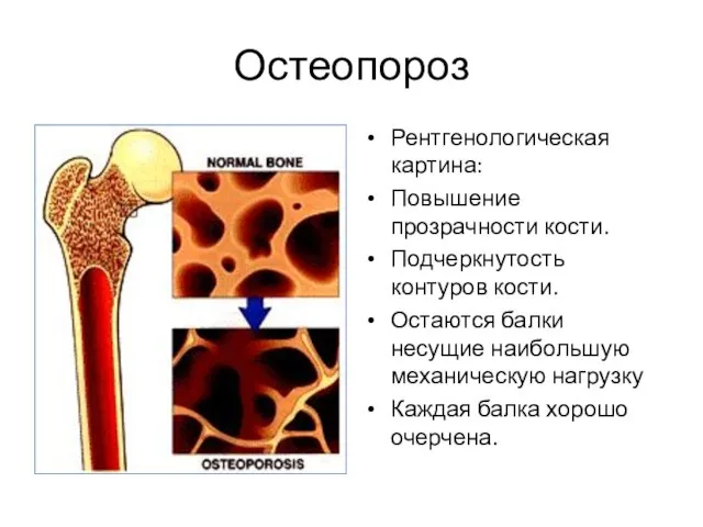 Остеопороз Рентгенологическая картина: Повышение прозрачности кости. Подчеркнутость контуров кости. Остаются балки